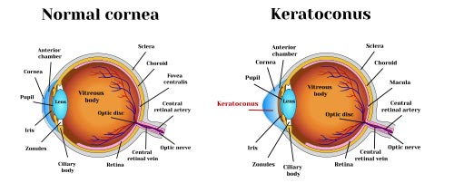 corneal surgery encino