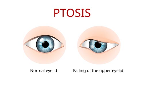 Oculoplastic Ptosis Treatment Encino